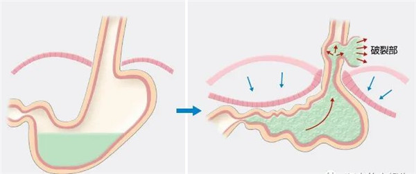 警惕致命的呕吐自发性食管破裂